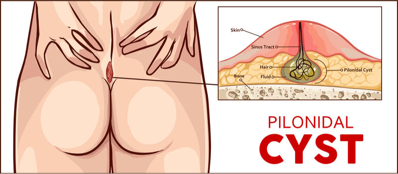Pilonidal Sinus Surgery